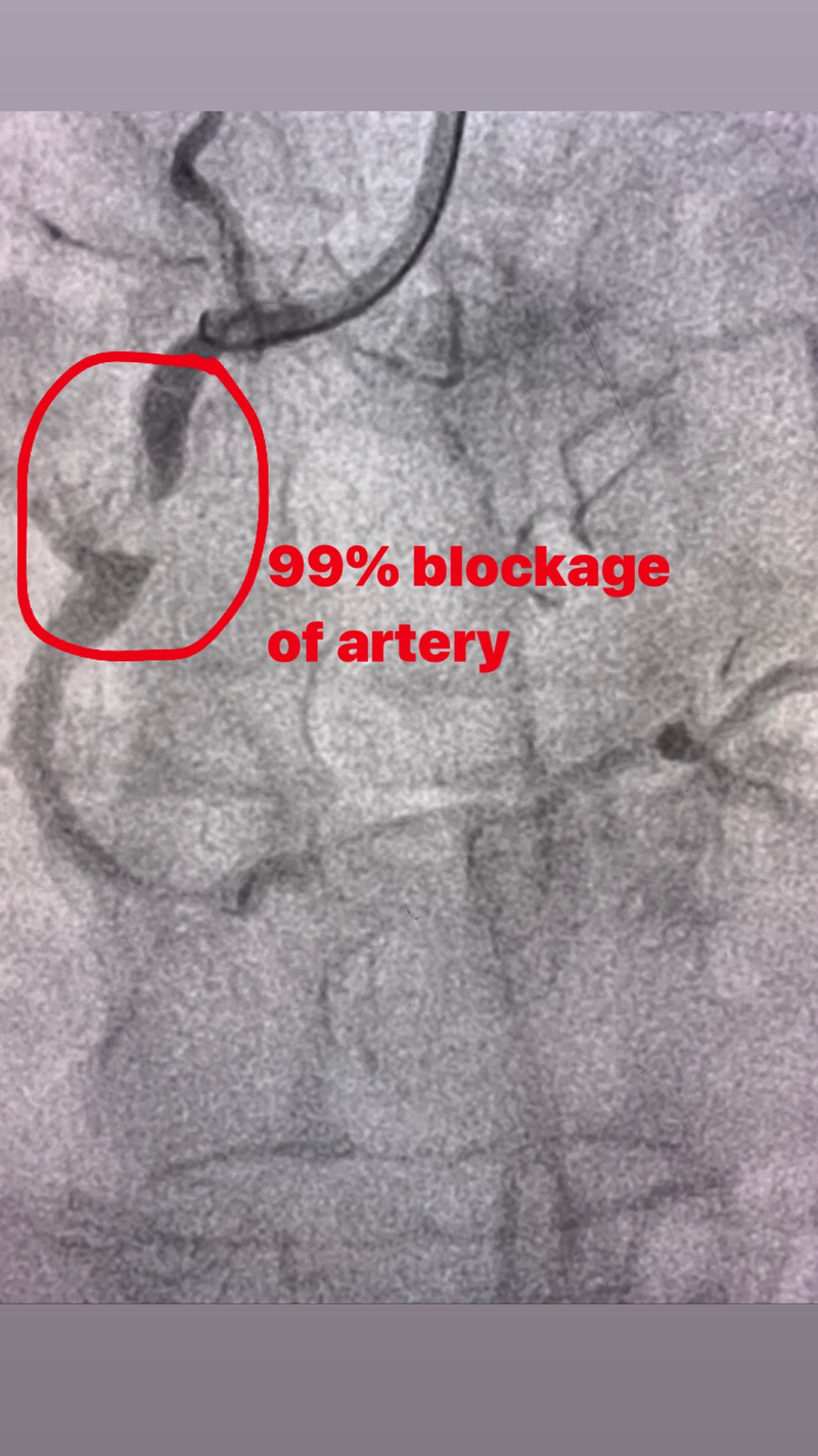 Illustration for article titled Cardiac Catheterization - it’s been a fun two days